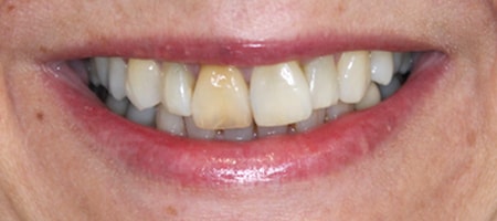 Before cosmetic Treatment Reading Smiles Before cosmetic Treatment Reading Smiles