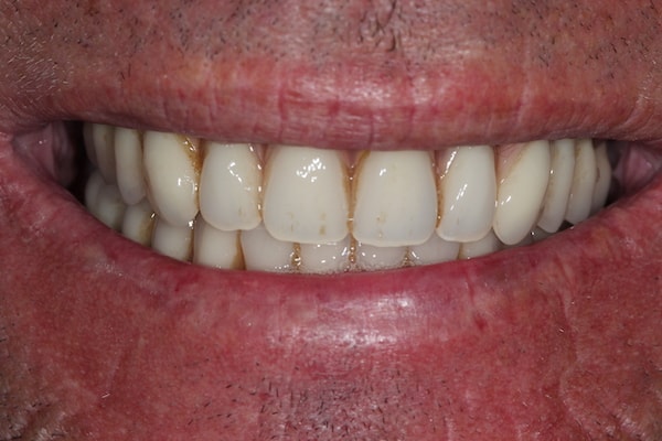 dental-implants-reading-case-2 After Invisalign Treatment Reading Smiles