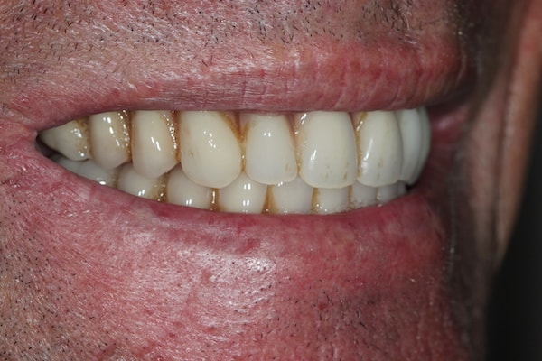 dental-implants-reading-case-3 After Invisalign Treatment Reading Smiles