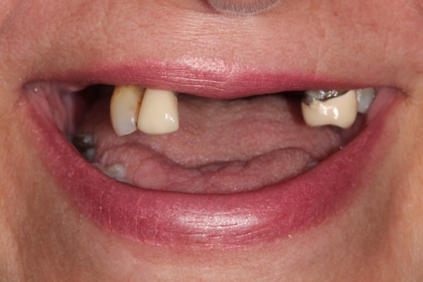 dental-implants-reading-case-31 Before Invisalign Treatment Reading Smiles