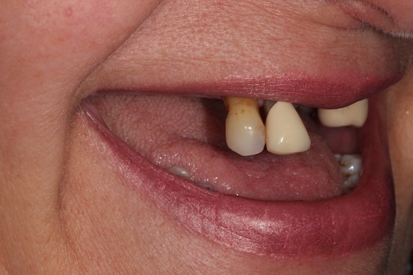 dental-implants-reading-case-32 Before Invisalign Treatment Reading Smiles