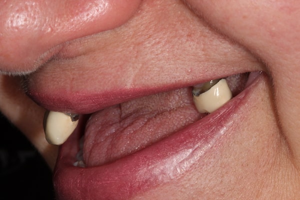 dental-implants-reading-case-33 Before Invisalign Treatment Reading Smiles