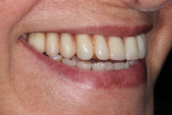 dental-implants-reading-case-35 After Invisalign Treatment Reading Smiles