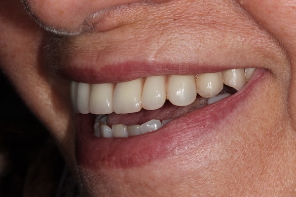 dental-implants-reading-case-36 After Invisalign Treatment Reading Smiles