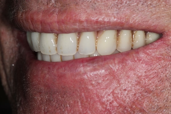 dental-implants-reading-case-4 After Invisalign Treatment Reading Smiles