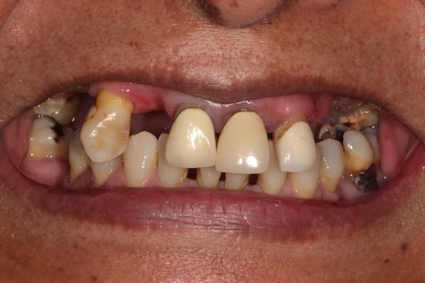 dental-implants-reading-case-41 Before Invisalign Treatment Reading Smiles