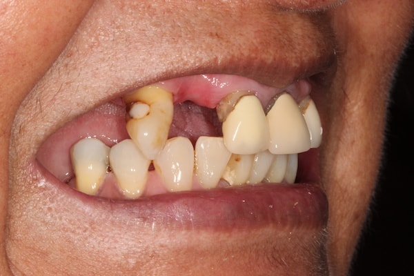 dental-implants-reading-case-42 Before Invisalign Treatment Reading Smiles