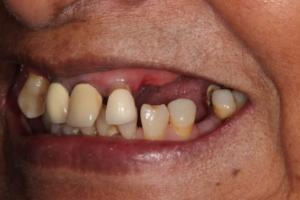 dental-implants-reading-case-43 Before Invisalign Treatment Reading Smiles