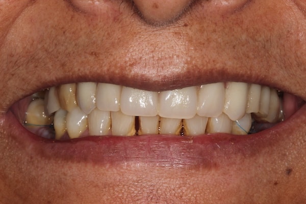 dental-implants-reading-case-44 After Invisalign Treatment Reading Smiles