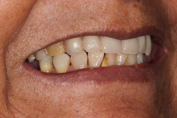 dental-implants-reading-case-45 After Invisalign Treatment Reading Smiles