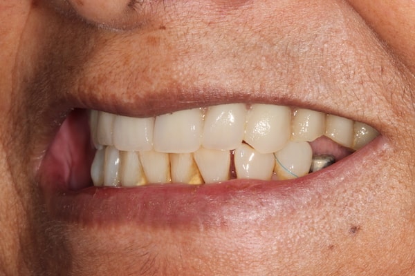 dental-implants-reading-case-46 After Invisalign Treatment Reading Smiles
