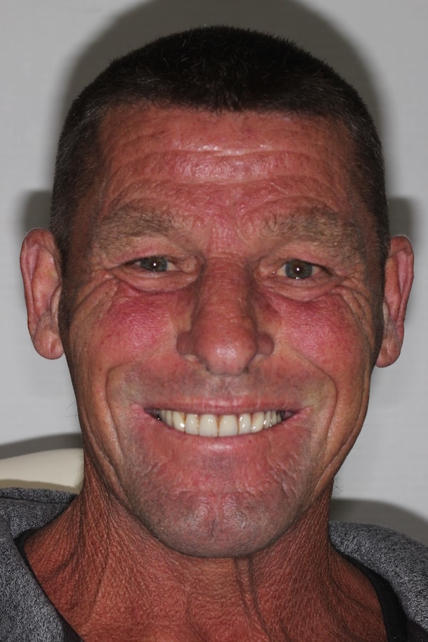 dental-implants-reading-case-5 After Invisalign Treatment Reading Smiles