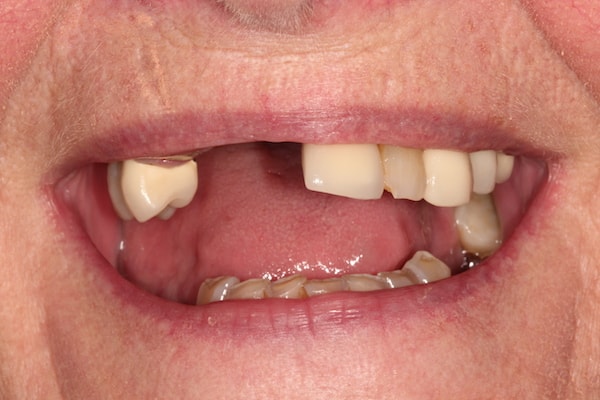 dental-implants-reading-case-51 Before Invisalign Treatment Reading Smiles