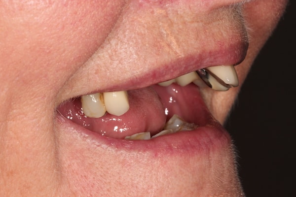 dental-implants-reading-case-52 Before Invisalign Treatment Reading Smiles