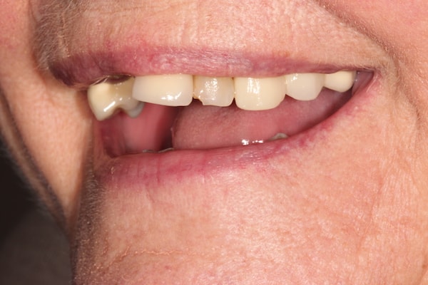 dental-implants-reading-case-53 Before Invisalign Treatment Reading Smiles