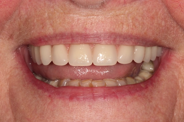 dental-implants-reading-case-54 After Invisalign Treatment Reading Smiles