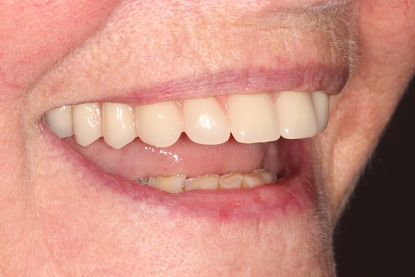 dental-implants-reading-case-55 After Invisalign Treatment Reading Smiles