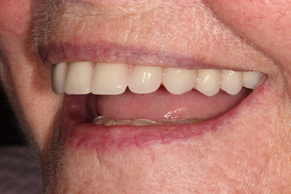 dental-implants-reading-case-56 After Invisalign Treatment Reading Smiles