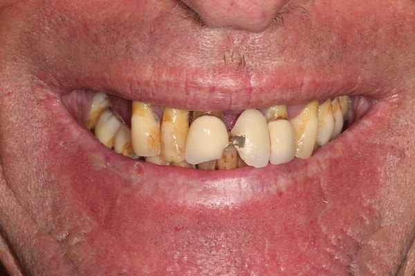 dental-implants-reading-case-6 Before & After Dental Implants