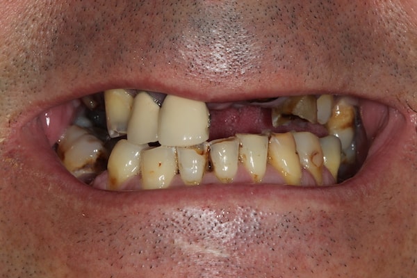 dental-implants-reading-case-61 Before Invisalign Treatment Reading Smiles