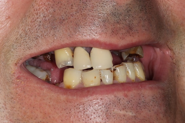 dental-implants-reading-case-62 Before Invisalign Treatment Reading Smiles