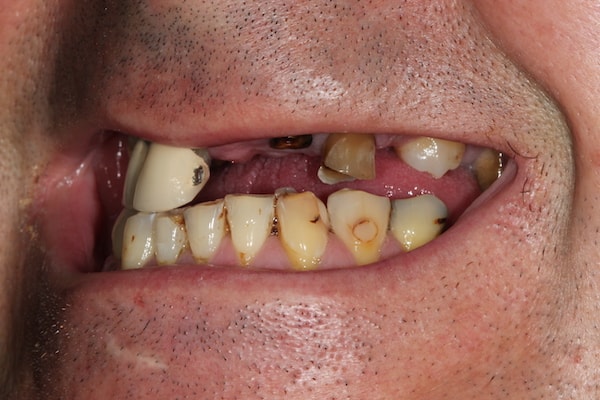 dental-implants-reading-case-63 Before Invisalign Treatment Reading Smiles