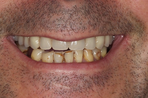 dental-implants-reading-case-64 After Invisalign Treatment Reading Smiles
