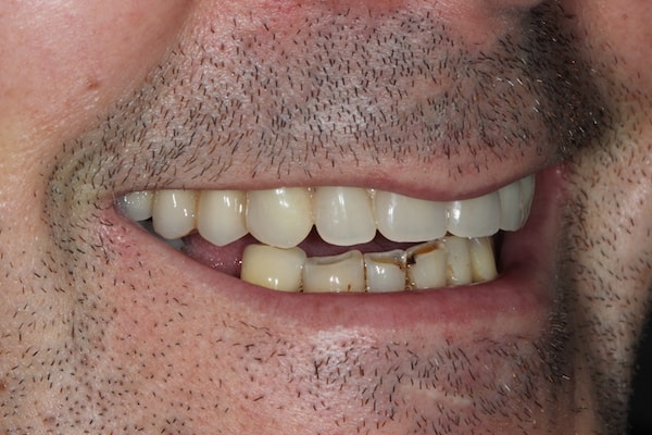 dental-implants-reading-case-65 After Invisalign Treatment Reading Smiles