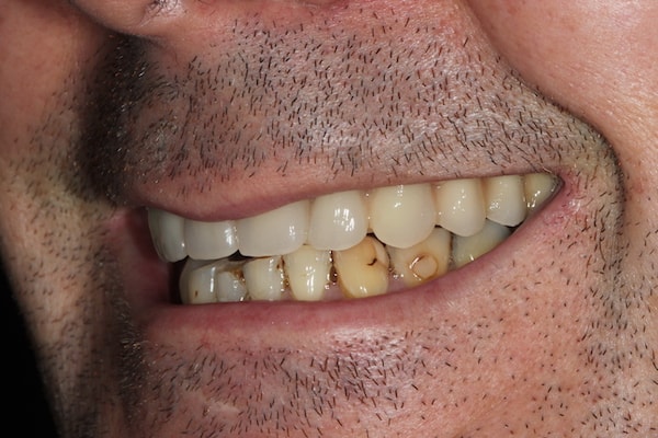 dental-implants-reading-case-66 After Invisalign Treatment Reading Smiles