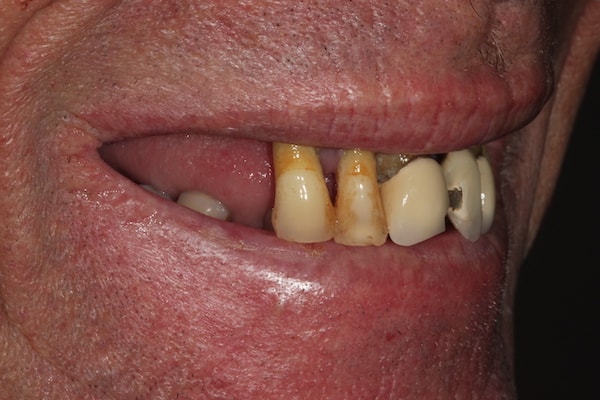 dental-implants-reading-case-7 Before & After Dental Implants