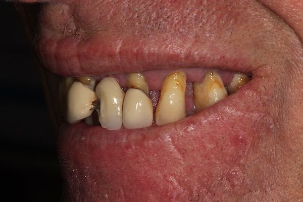 dental-implants-reading-case-8 Before & After Dental Implants