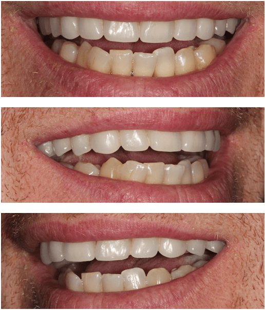 dental-implants-reading