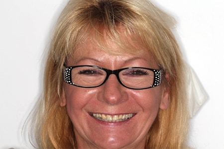 Before Smile Makeover Treatment Reading Smiles Before Smile Makeover Treatment Reading Smiles