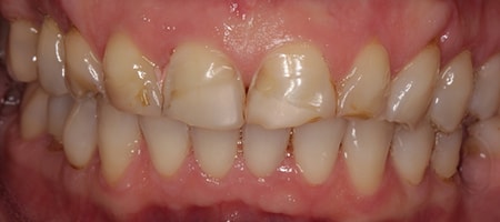 Before Smile Makeover Treatment Reading Smiles Before Smile Makeover Treatment Reading Smiles