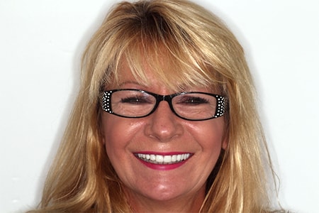 After Smile Makeover Treatment Reading Smiles After Smile Makeover Treatment Reading Smiles