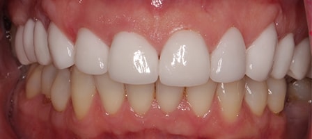 After Smile Makeover Treatment Reading Smiles After Smile Makeover Treatment Reading Smiles