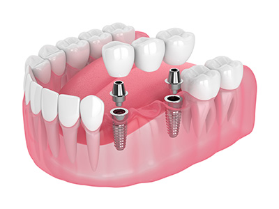 few-implants