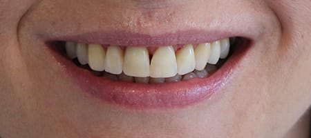 After Invisalign Treatment Reading Smiles After Invisalign Treatment Reading Smiles