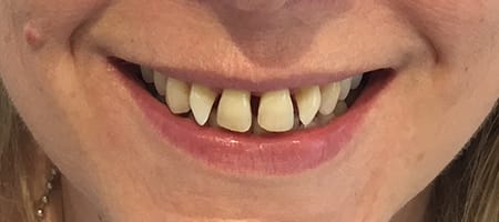 Before Invisalign Treatment Reading Smiles Before Invisalign Treatment Reading Smiles