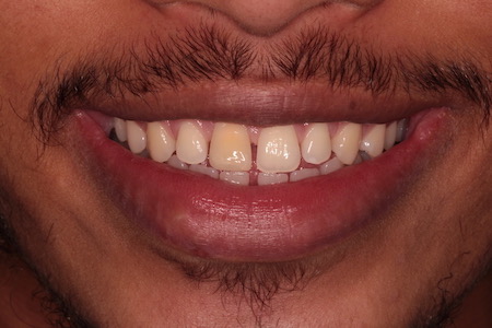 Before Smile Makeover Treatment Reading Smiles Before Smile Makeover Treatment Reading Smiles