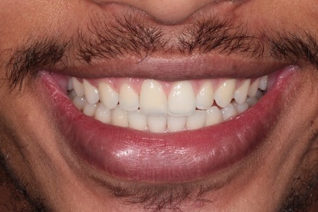 After Smile Makeover Treatment Reading Smiles After Smile Makeover Treatment Reading Smiles