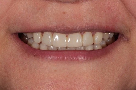 After Veneers Treatment Reading Smiles After Veneers Treatment Reading Smiles