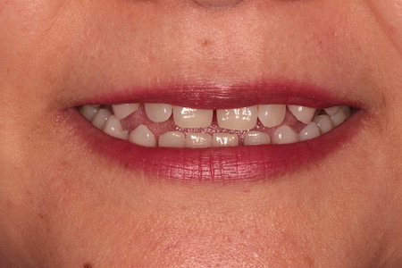 Before veneers Treatment Reading Smiles Before veneers Treatment Reading Smiles