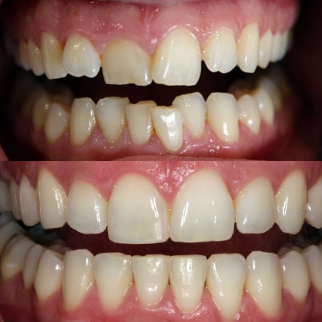 Invisalign before after 4
