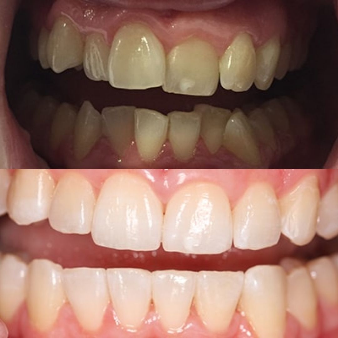 Invisalign before after 5