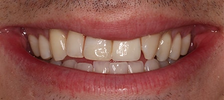 After Smile Makeover Treatment Reading Smiles After Smile Makeover Treatment Reading Smiles