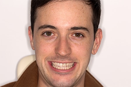Before Smile Makeover Treatment Reading Smiles Before Smile Makeover Treatment Reading Smiles