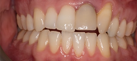 Before Smile Makeover Treatment Reading Smiles Before Smile Makeover Treatment Reading Smiles