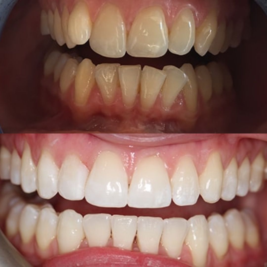 reading-invisalign-before-after-case-1
