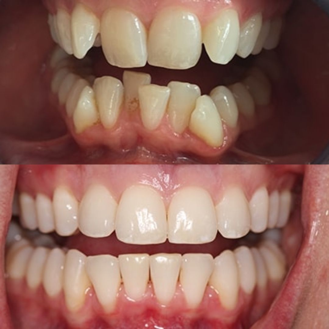 reading-invisalign-before-after-case-2